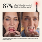Helios Red + Blue Light Toothbrush