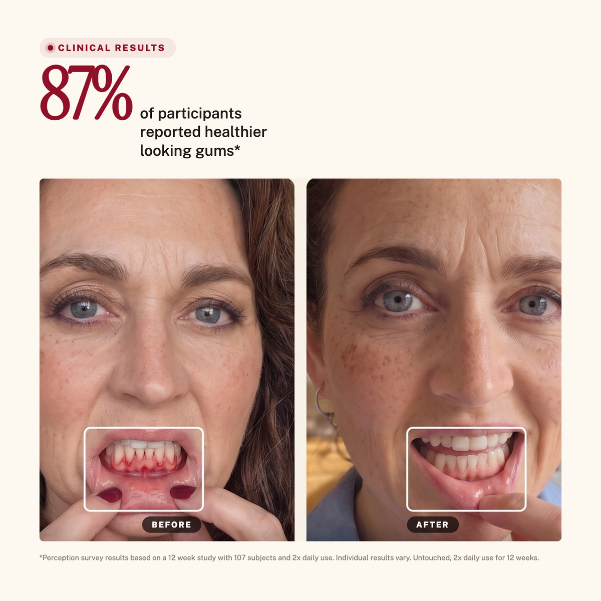 Sirius Red + Blue Light Toothbrush — 87% of participants reported healthier looking gums